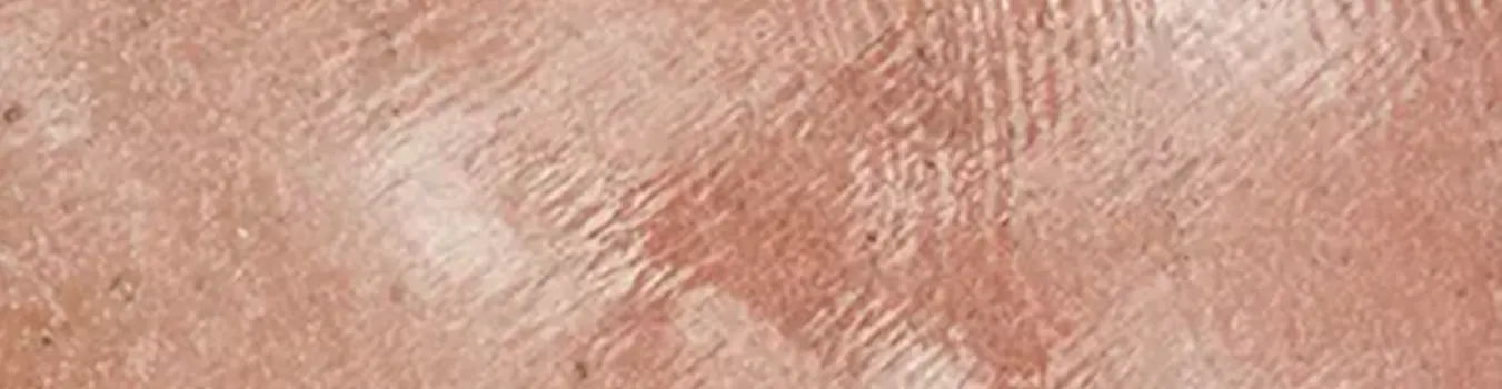 Tsikeloudi Blog - Οκτώβριος: μήνας ευαισθητοποίησης για το έκζεμα